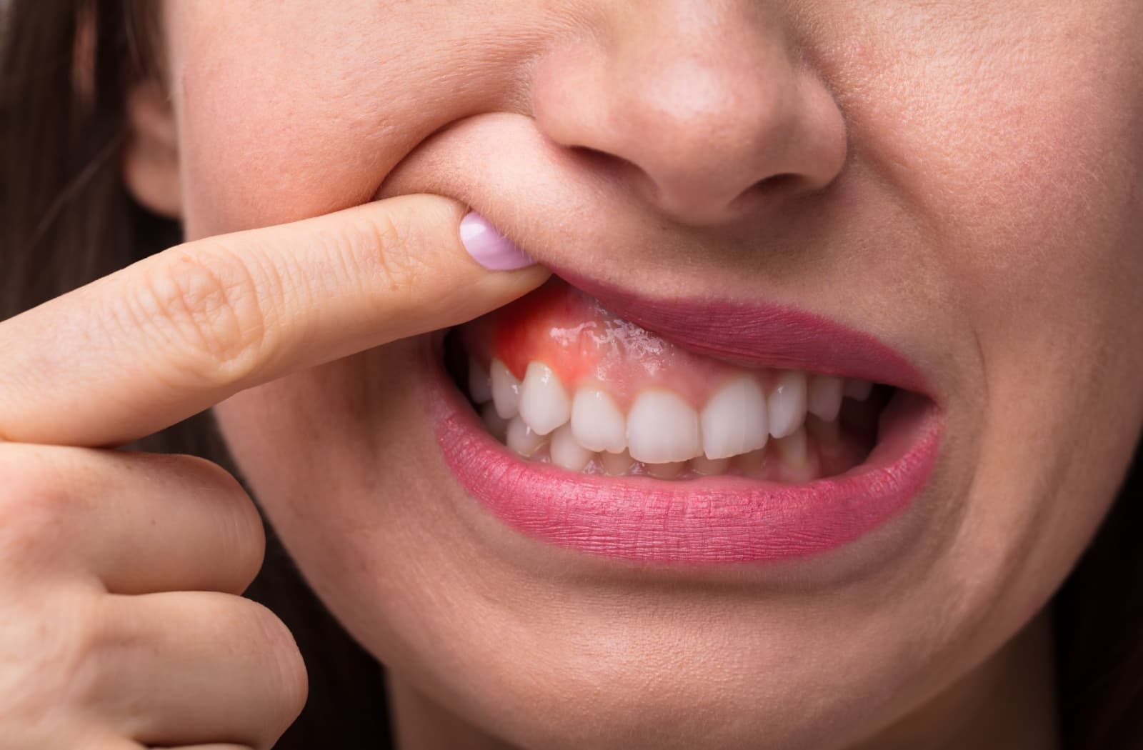 Close-up of a person's mouth as they lift up their lip and reveal inflamed gums.